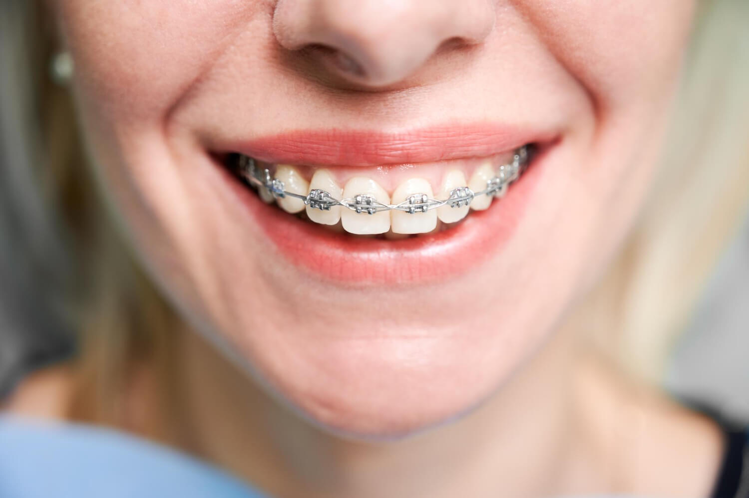 Ortodontia aparelho dentário dentista aricanduva