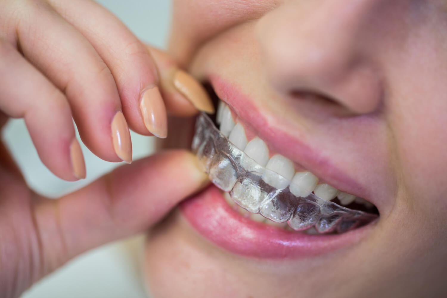 Alinhador Invisível Funciona Mesmo? A Verdade Sobre o Tratamento com Invisalign no Aricanduva